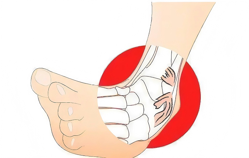 踝關(guān)節扭傷